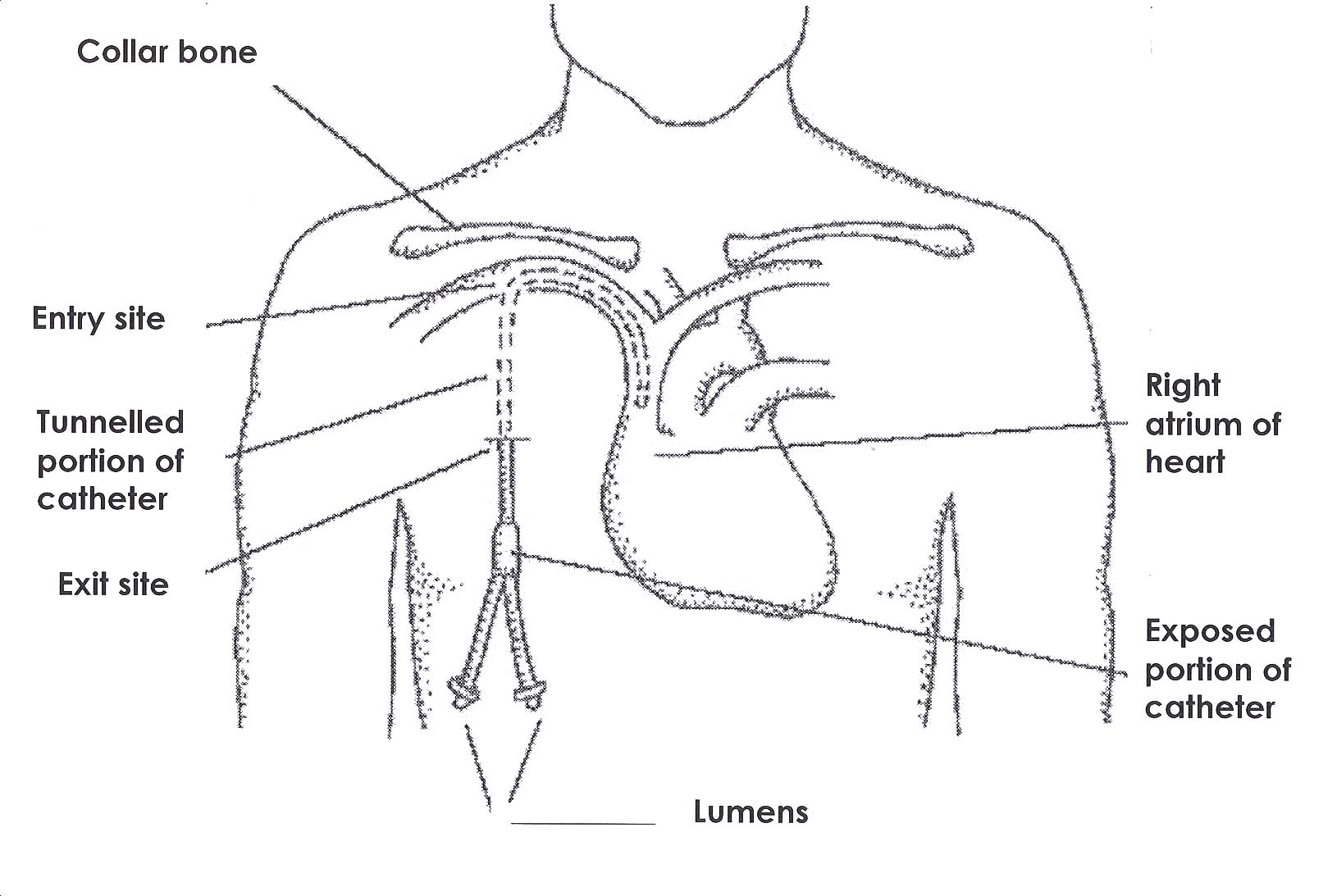 Your Hickman line