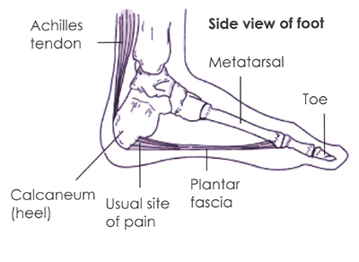 planters fasciitis nhs